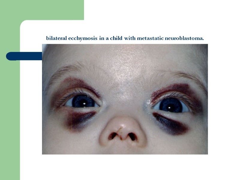 bilateral ecchymosis in a child with metastatic neuroblastoma.